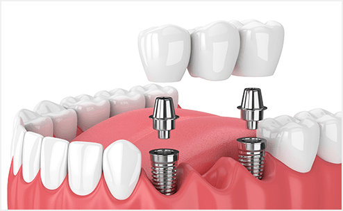 歯が抜けた時の治療について