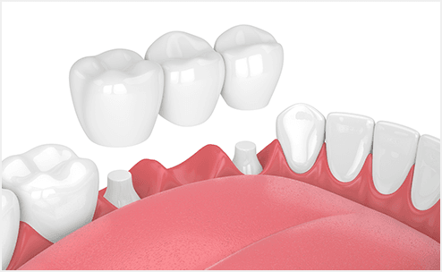 歯が抜けた時の治療について