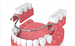 歯が抜けた時の治療について