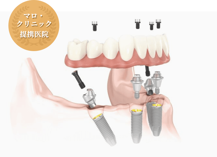 身体への負担が少なく、さらに正確かつ安全なシステムです